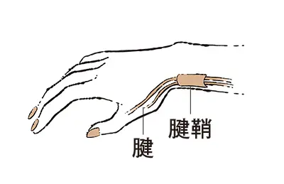 2. 親指側の手首が痛む “ドケルバン病の画像_1