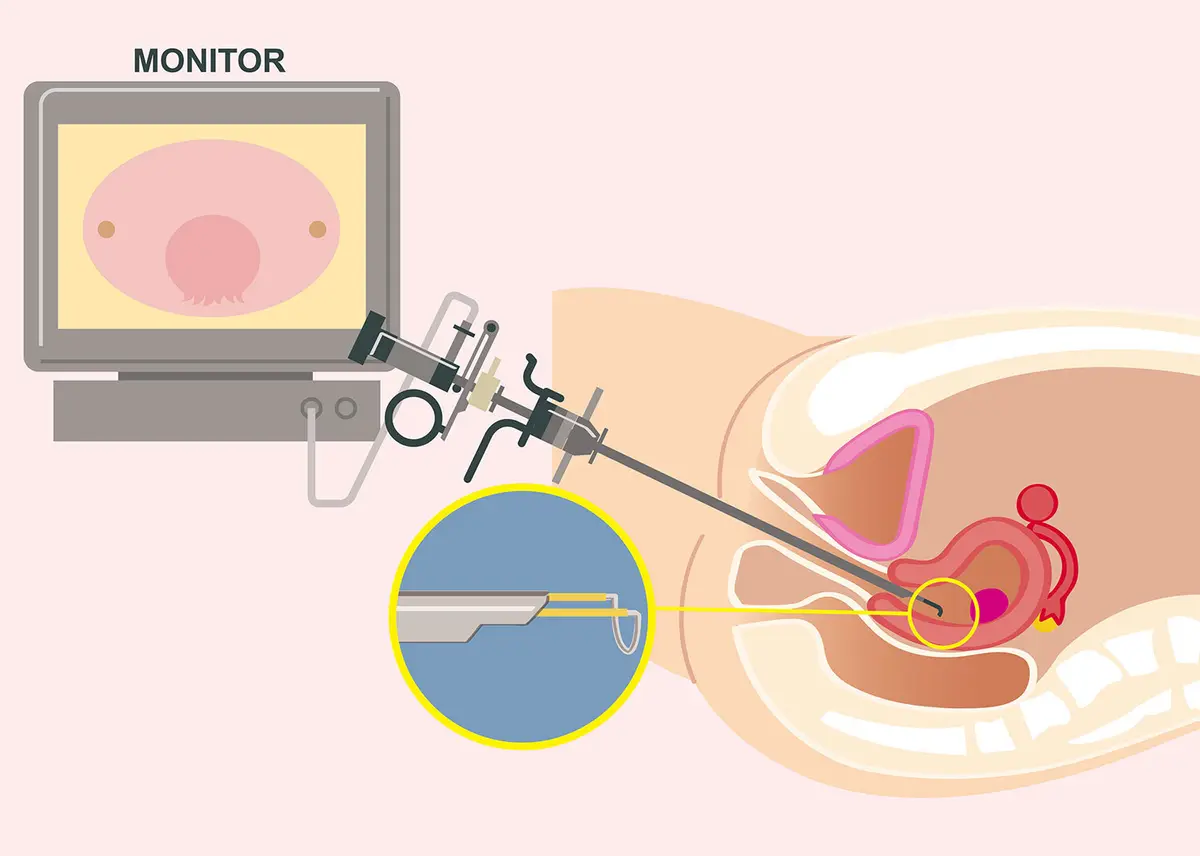 OurAge×Webエクラ　子宮鏡下手術