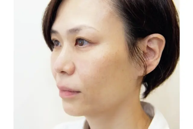 ヒアルロン酸　施術後