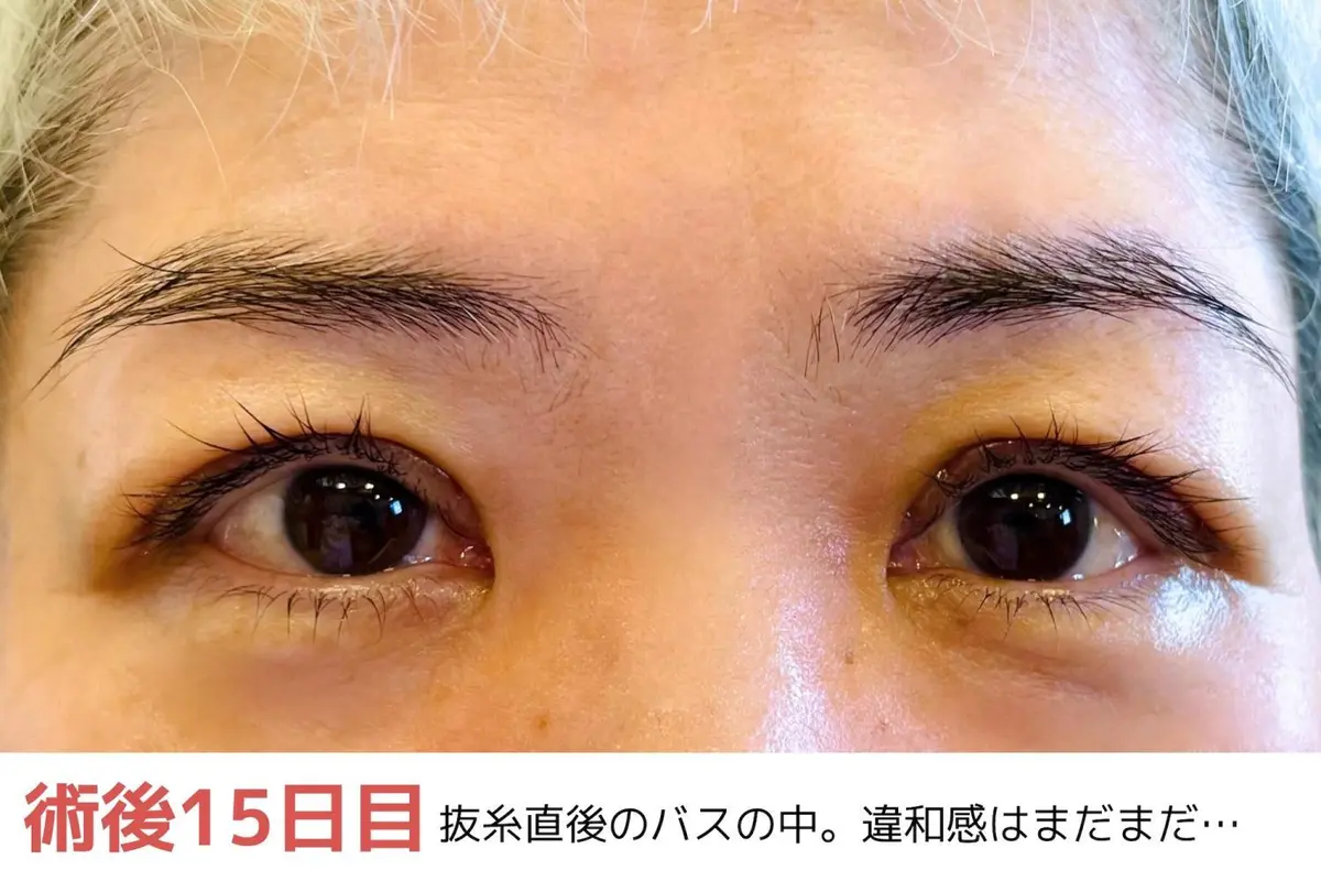 OurAge×Webエクラ　術後15日目　抜糸直後のバスの中。違和感はまだまだ…