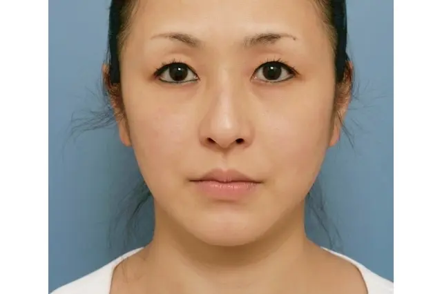 ウルサーマ　施術後