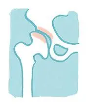 OurAge×Webエクラ　変形性膝関節症　解剖図