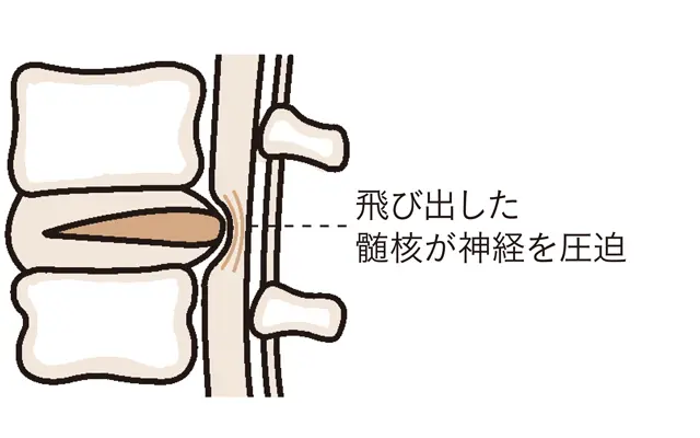 腰椎椎間板ヘルニア