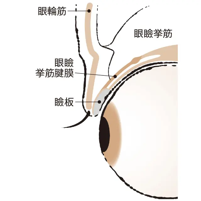 2タイプある眼瞼下垂