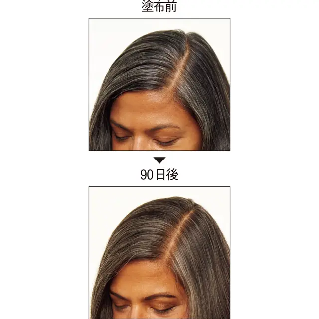 ブラックリバース処方の美容液を90日間連用した50代女性。