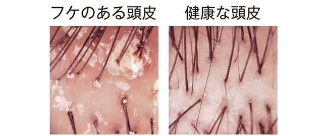 フケのある頭皮と健康な頭皮