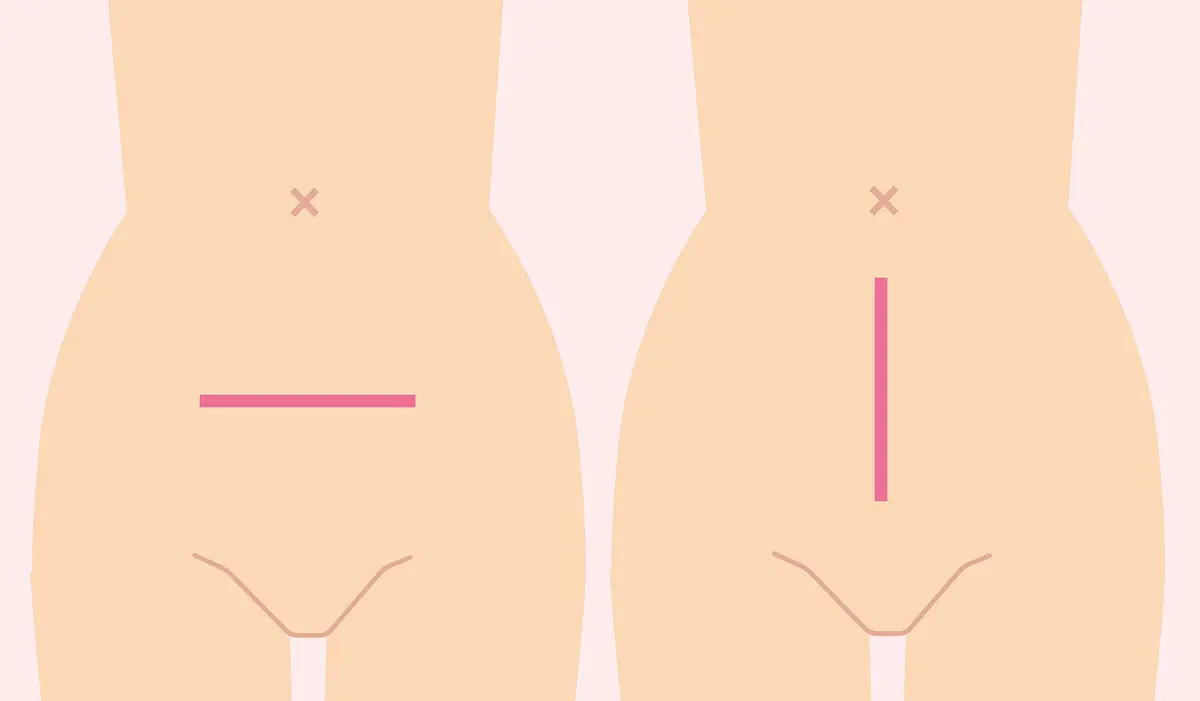 OurAge×Webエクラ　開腹手術_横切りと縦切り