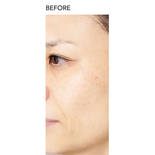 「美容クリニックでシミとり」企画の2年後の点在ジミを追ってみた！（体験者／エクラエディター K野）