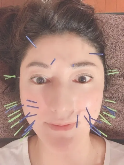 美容針で小顔に❗️の画像_2