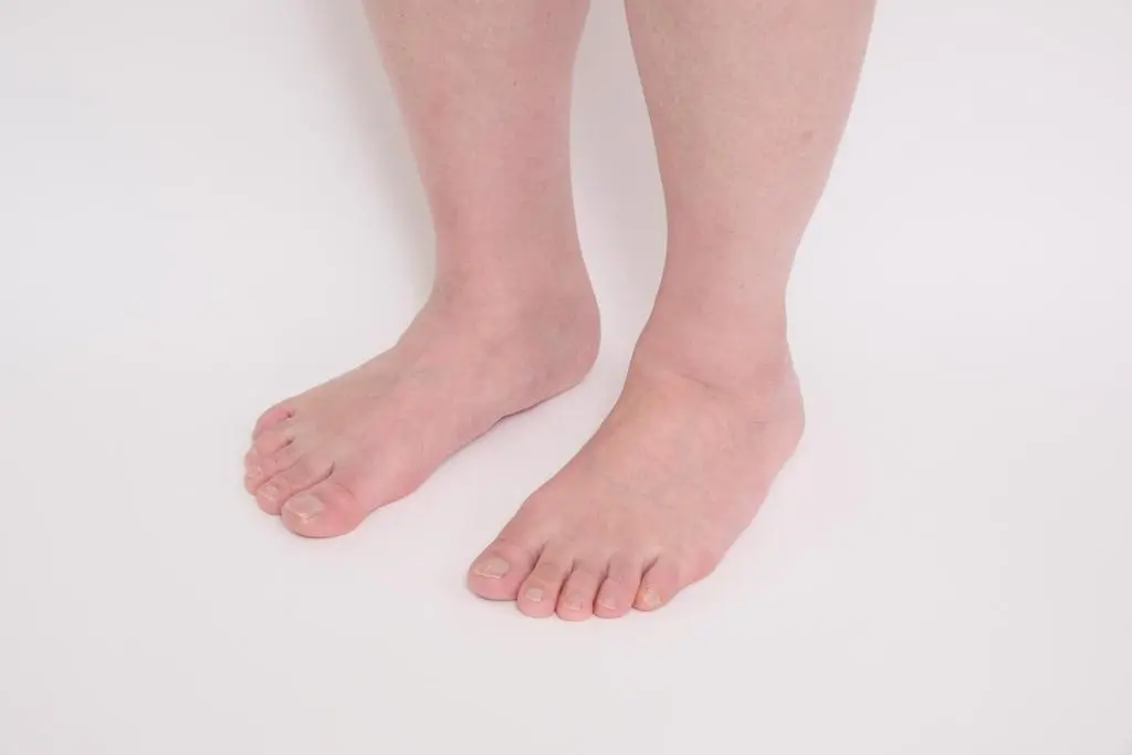 OurAge×Webエクラ　アーチが崩れ、土踏まずがなくなっている