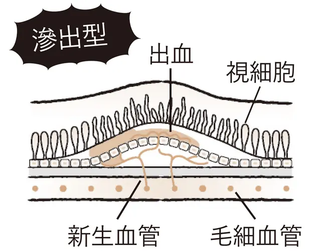 非常にもろい新生血管が破れることで視覚障害につながる「滲出型」