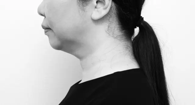 【施術前】二重あごが気になる