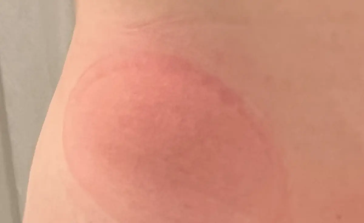 クールスカルプティング エリート　終了後