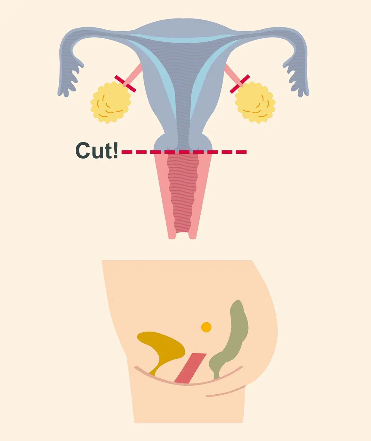 OurAge×Webエクラ　普通は子宮頸部まで取る