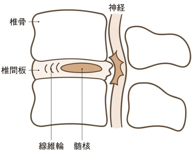 ぎっくり腰　これが痛みの原因のひとつ！