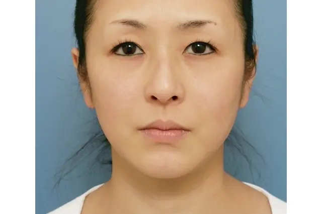 ウルサーマ　施術前