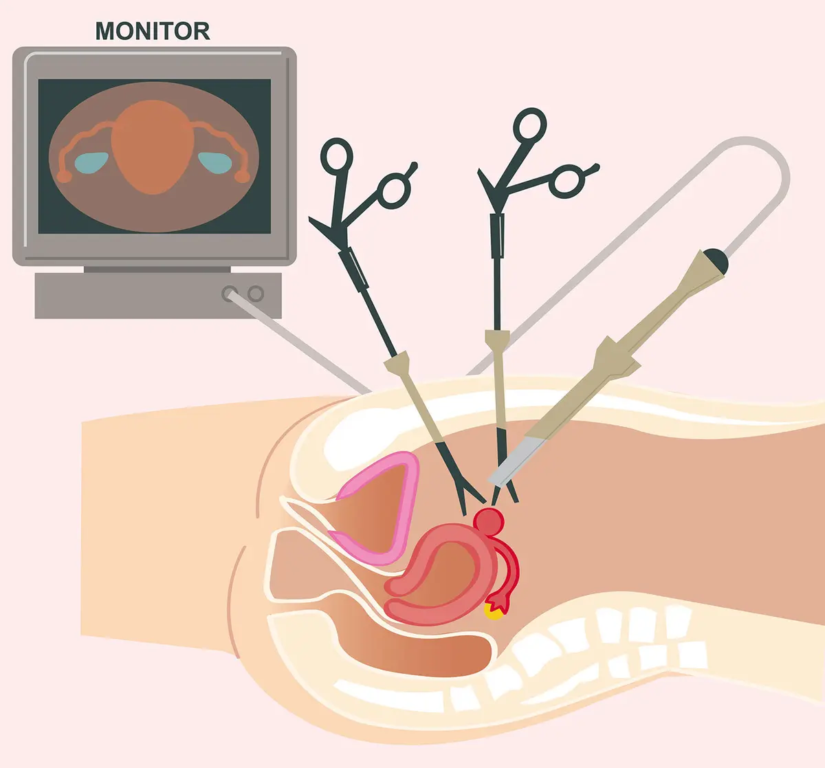 OurAge×Webエクラ　腹腔鏡下手術／イラスト