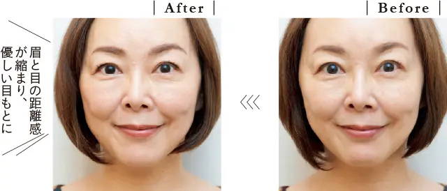 目もとハイフシャワー施術後の変化