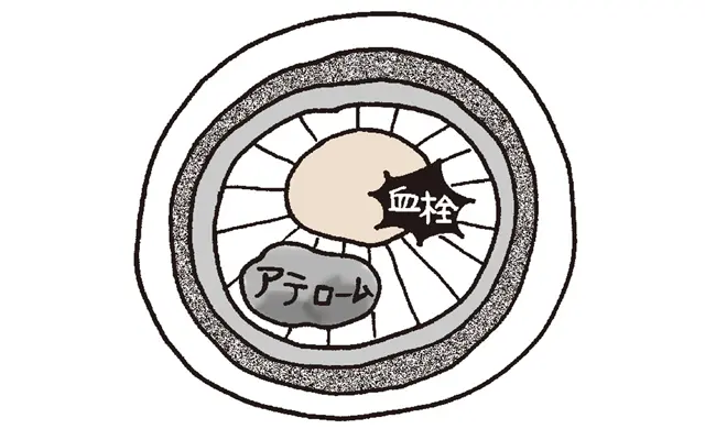 動脈硬化のすすみ方4
