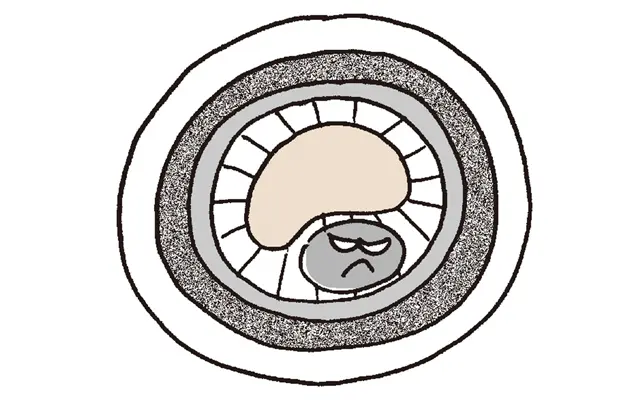 動脈硬化のすすみ方2