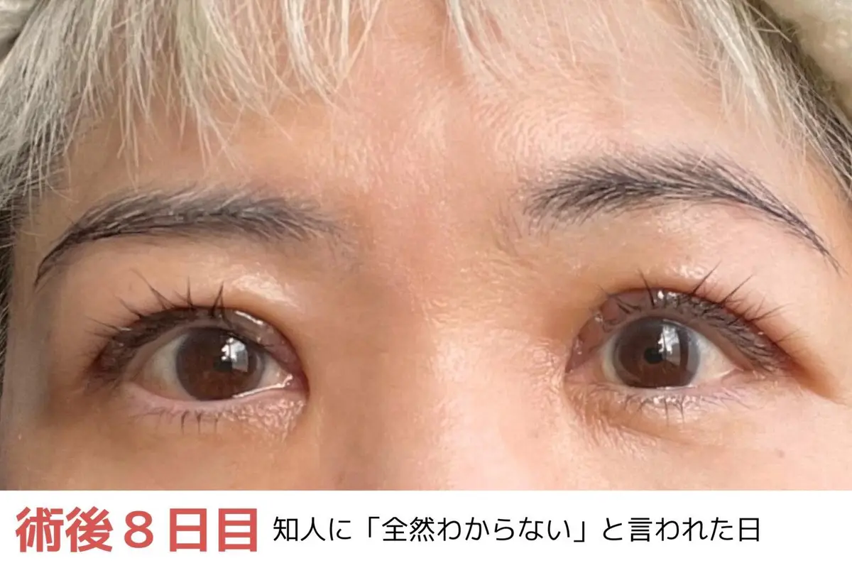 OurAge×Webエクラ　術後８日目　知人に「全然わからない」と言われた日