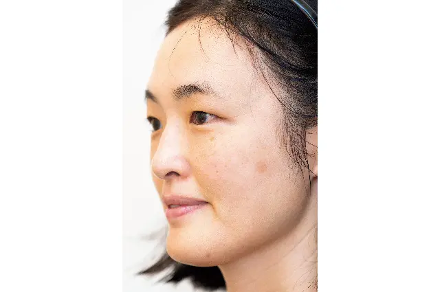 「初めてのシミとり」施術体験レポート①メの画像_2