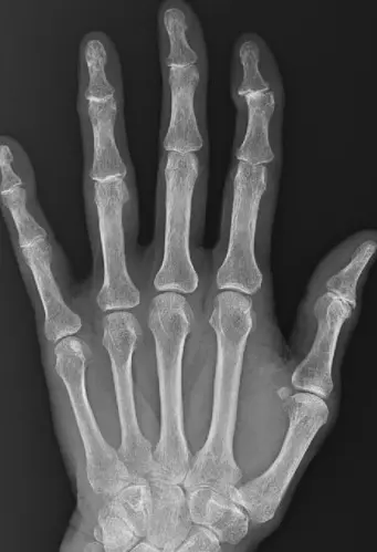 人さし指の第一関節にずれが生じることで曲がる。