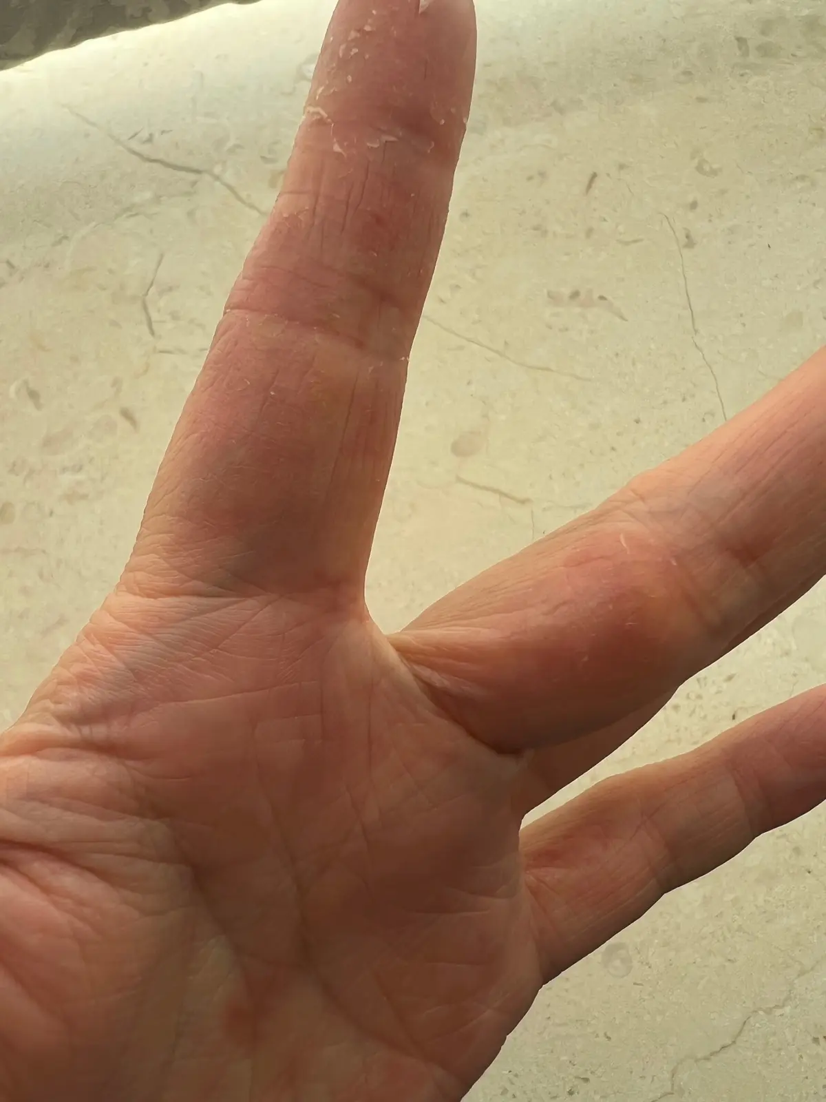 主婦手湿疹。人差し指の腹、中指との股の部分の荒れがおさまり、カサカサ感がなくなりました