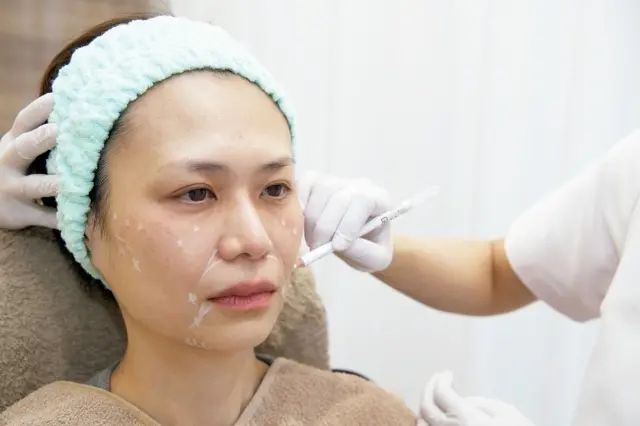 ヒアルロン酸注射　施術中