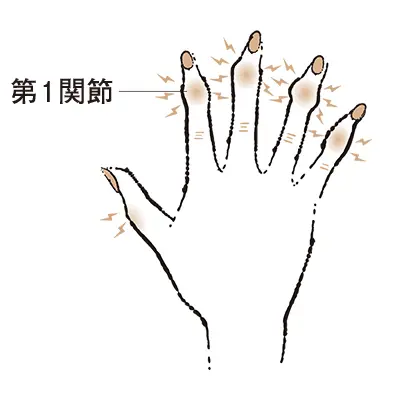 4. 第1関節が腫れ、変形する “べバーの画像_1
