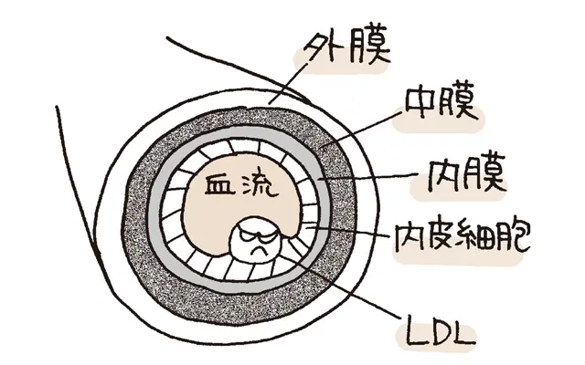 動脈硬化のすすみ方1