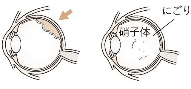 急に増えた場合は網膜剥離かも!?