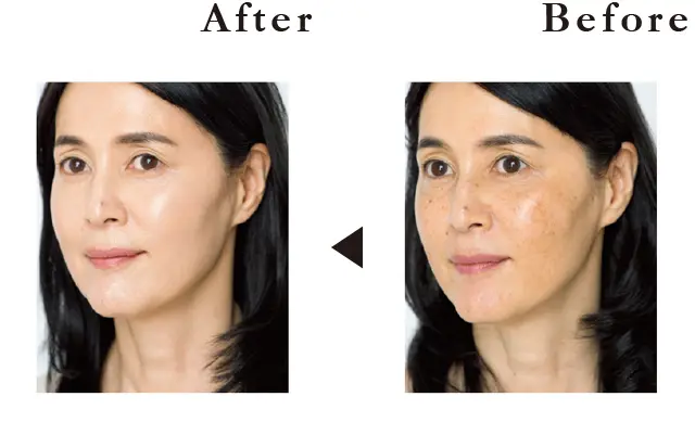 フローレスフィットビフォーアフター