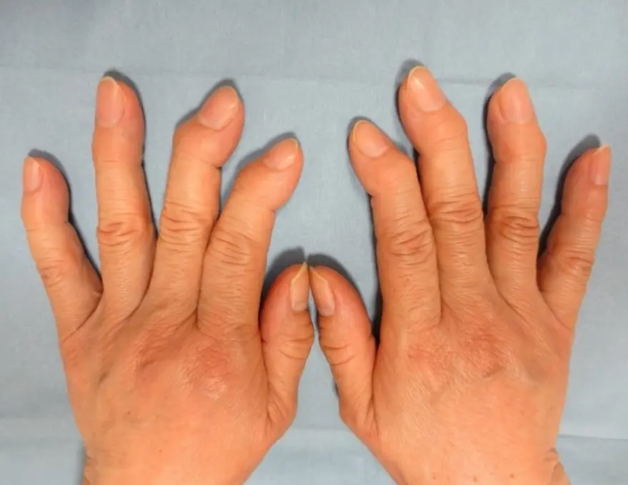 『へバーデン結節』の炎症が進み、第一関節が曲がったケース。