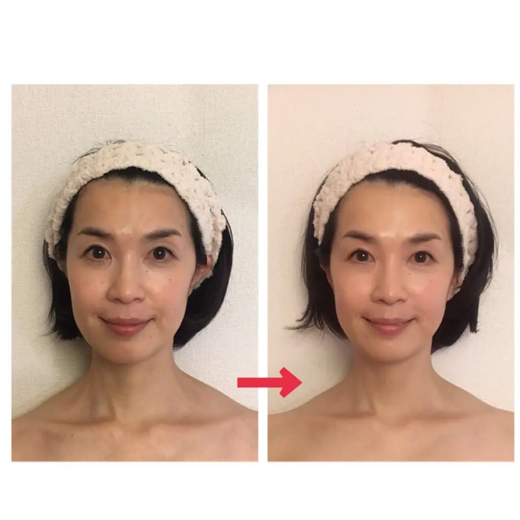 まるで整形。本来の自分が表れる口内エステの画像_1