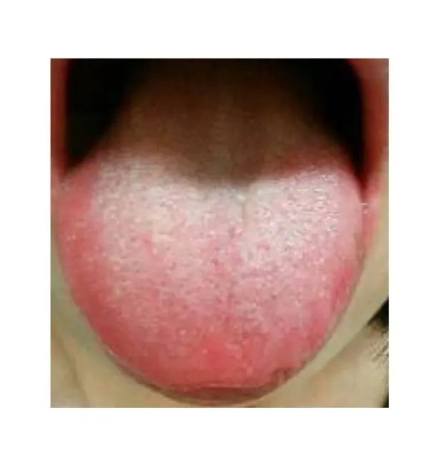 OurAge×Webエクラ イライラしやすく、怒りやすい舌の状態