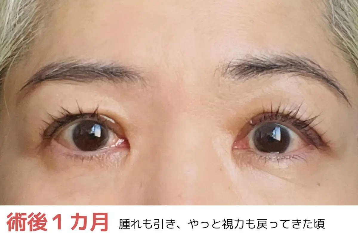 OurAge×Webエクラ　術後1ヵ月　腫れも引き、やっと視力も戻ってきた頃