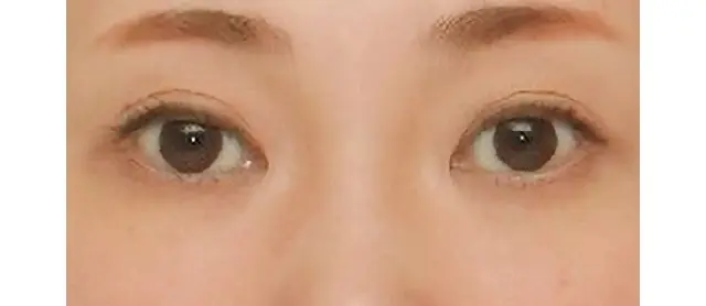 サーマクールアイ　施術後