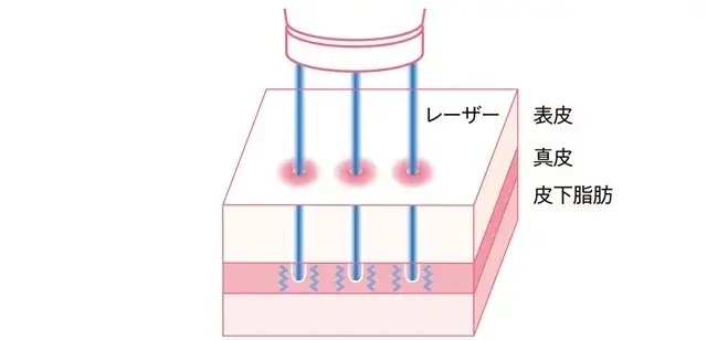 老け見えの原因は「たるみ毛穴」!? 50の画像_39