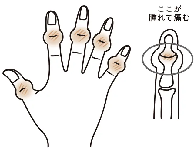 へバーデン結節