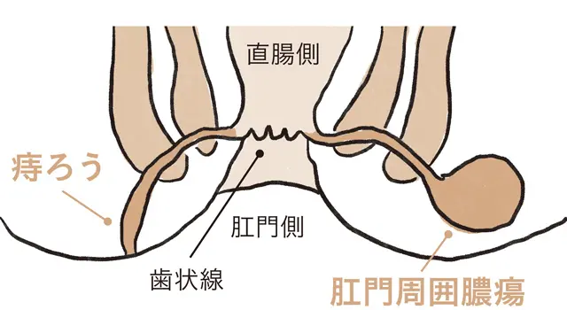 痔ろう（あな痔）