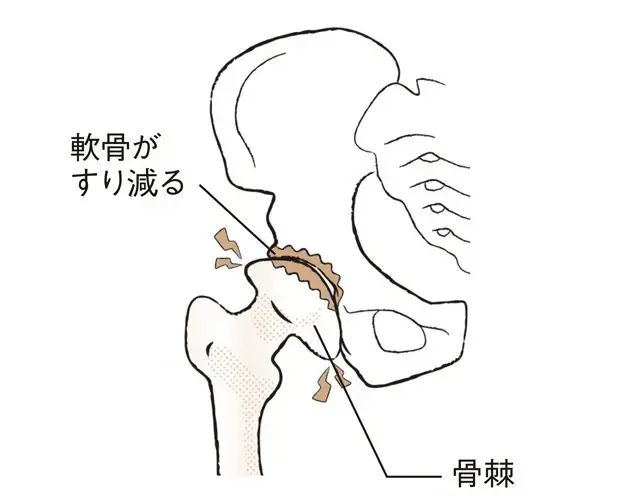 変形性股関節症の股関節