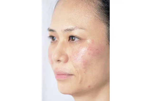 「初めてのシミとり」施術体験レポート②年の画像_4