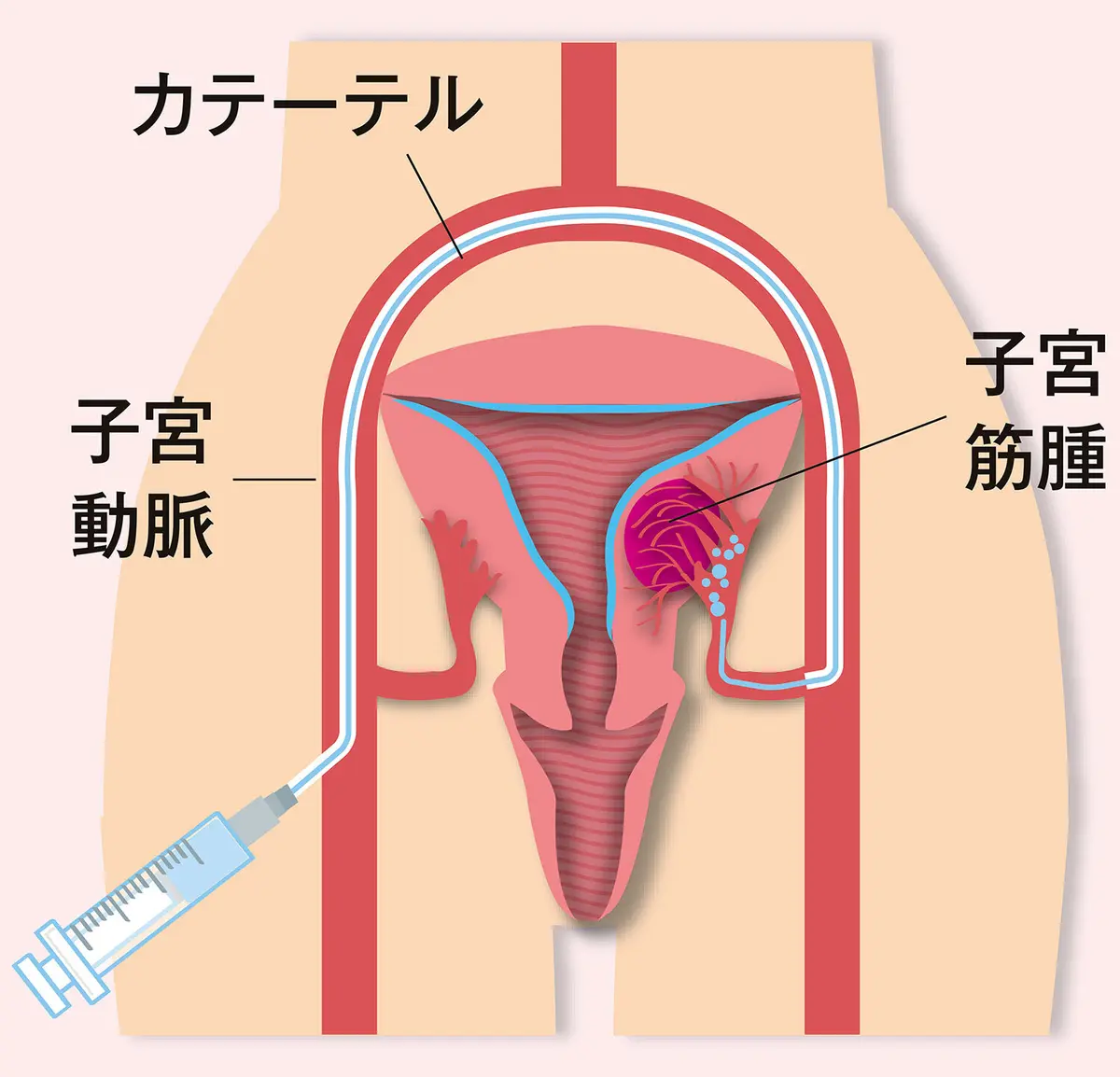 OurAge×Webエクラ　UAE（子宮動脈塞栓術）