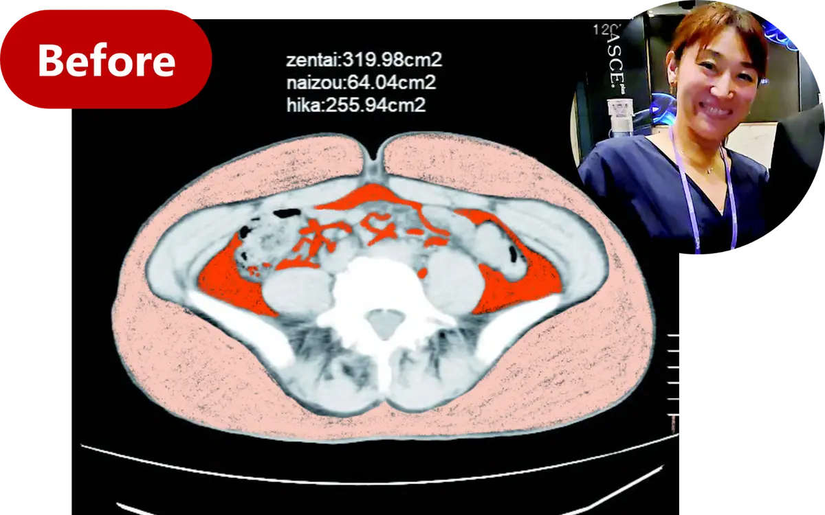 OurAge×Webエクラ　BEFORE 内臓脂肪……64.04㎠ 皮下脂肪……255.94㎠ 合計 …………319.98㎠