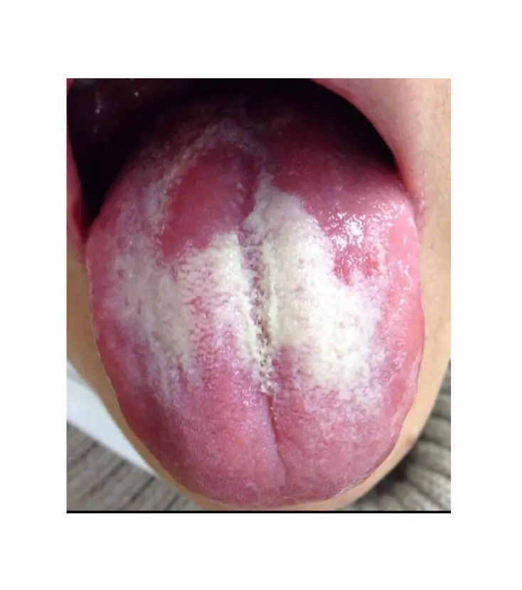 OurAge×Webエクラ 胃腸の疲れ、長引く風邪、睡眠の質の低下で疲れがぬけないなどの症状がある舌