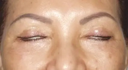 OurAge×Webエクラ　手術後、眼が閉じにくくなった