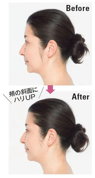 頬の斜面にハリ