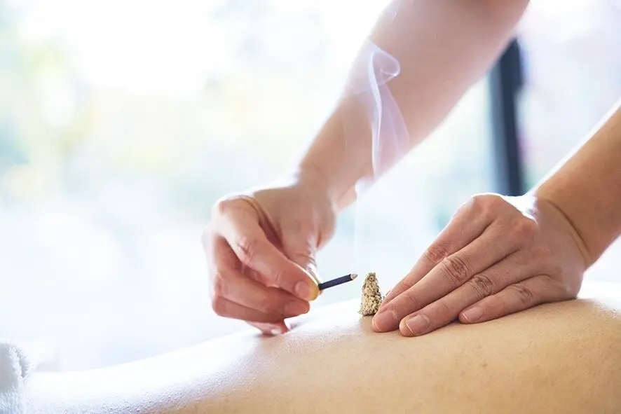 東洋医学に基づいた”鍼灸”は「アマネム」のスパ施術のひとつ