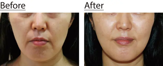 超音波治療「ダブロ」でコラーゲンを増やす　クリニックでケア